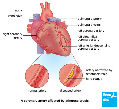 Heart Attack_Atherosclerosis-Eng