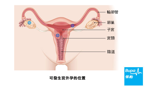 宮外孕 健康a Z 健康資訊 保柏醫療保險