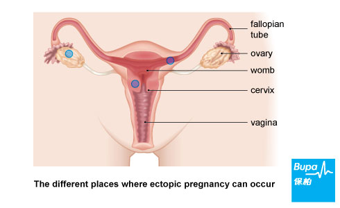 Etcopic pregnancy