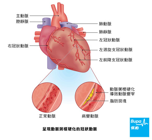突發性心臟病