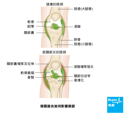 骨性關節炎
