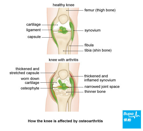 Osteoarthritis