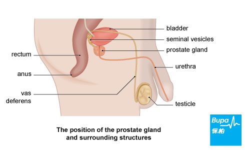prostate cancer
